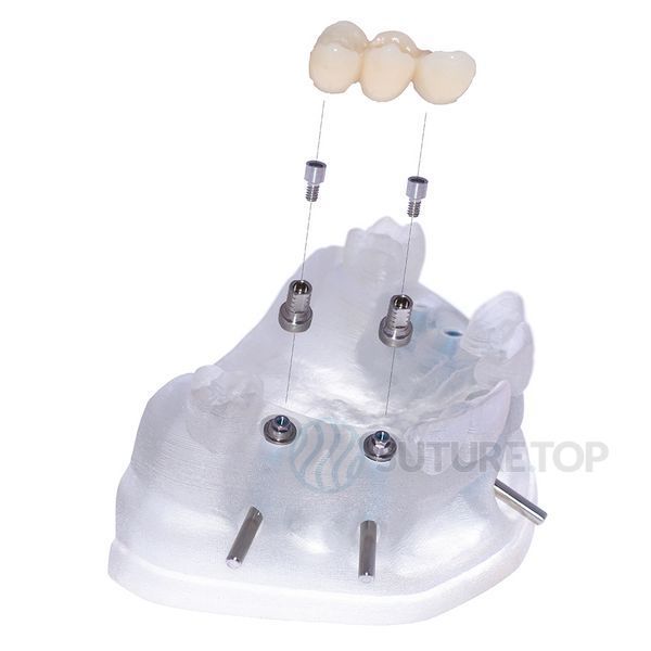 Короткий титановий ковпачок для Мультиюніт абатменту Short Titanium sleeve for Multi-Unit abutment MU-50TS Cortex Dental Implants Мультиюніт Платформа Multi-Unit Platform фото MU-50TS